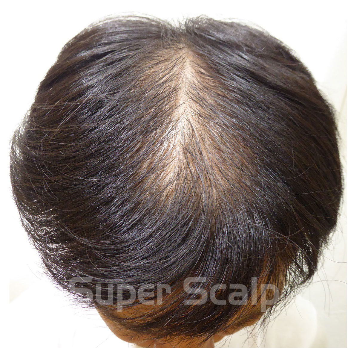 AGAをお薬無しで改善し発毛に導いた秘訣とは？