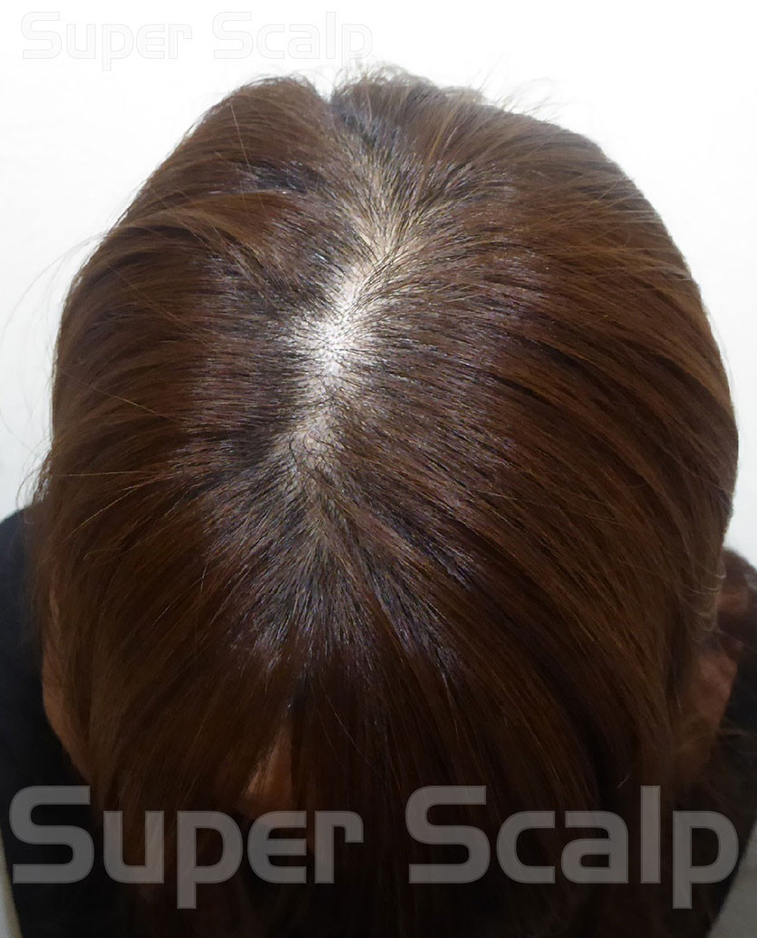 女性20代分け目が広くなって落ち込みました・・・