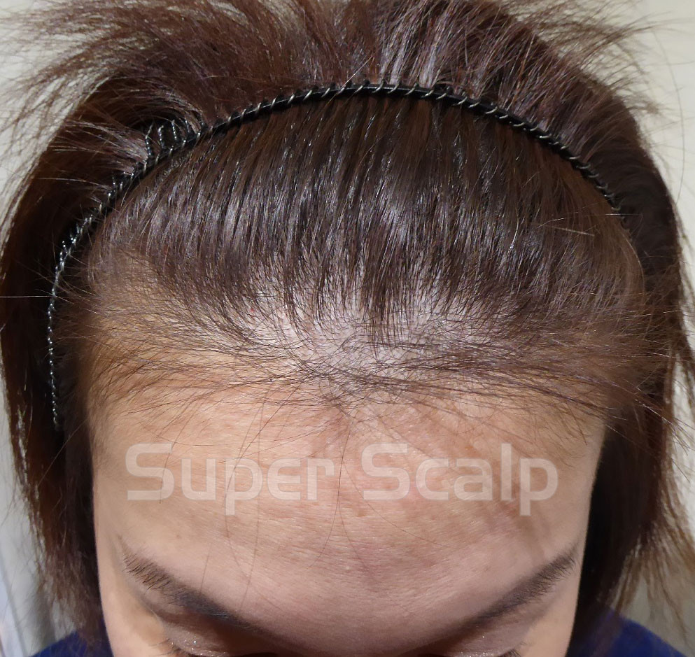 30代独身女性の薄毛対策、何から始める？