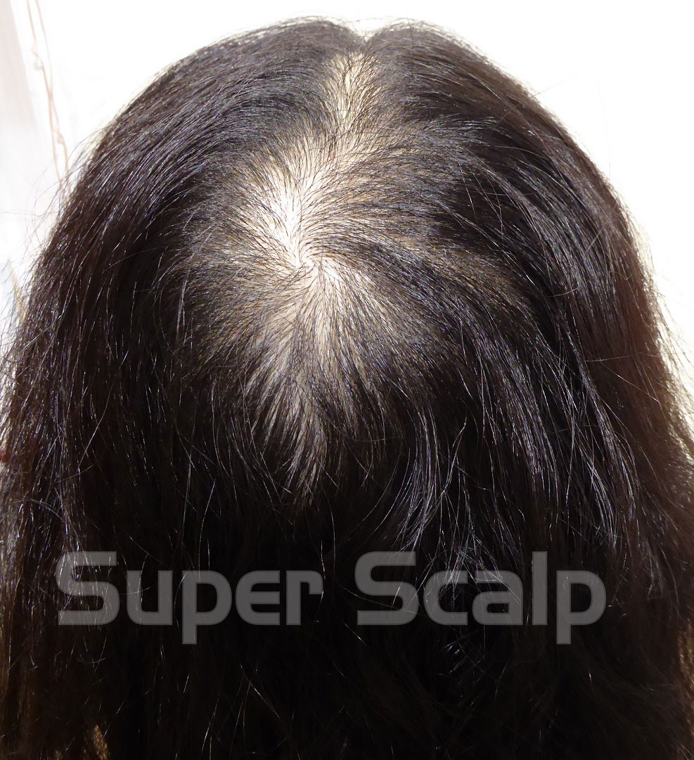 過去に大手で増毛、クリニックでお薬を飲まれていました