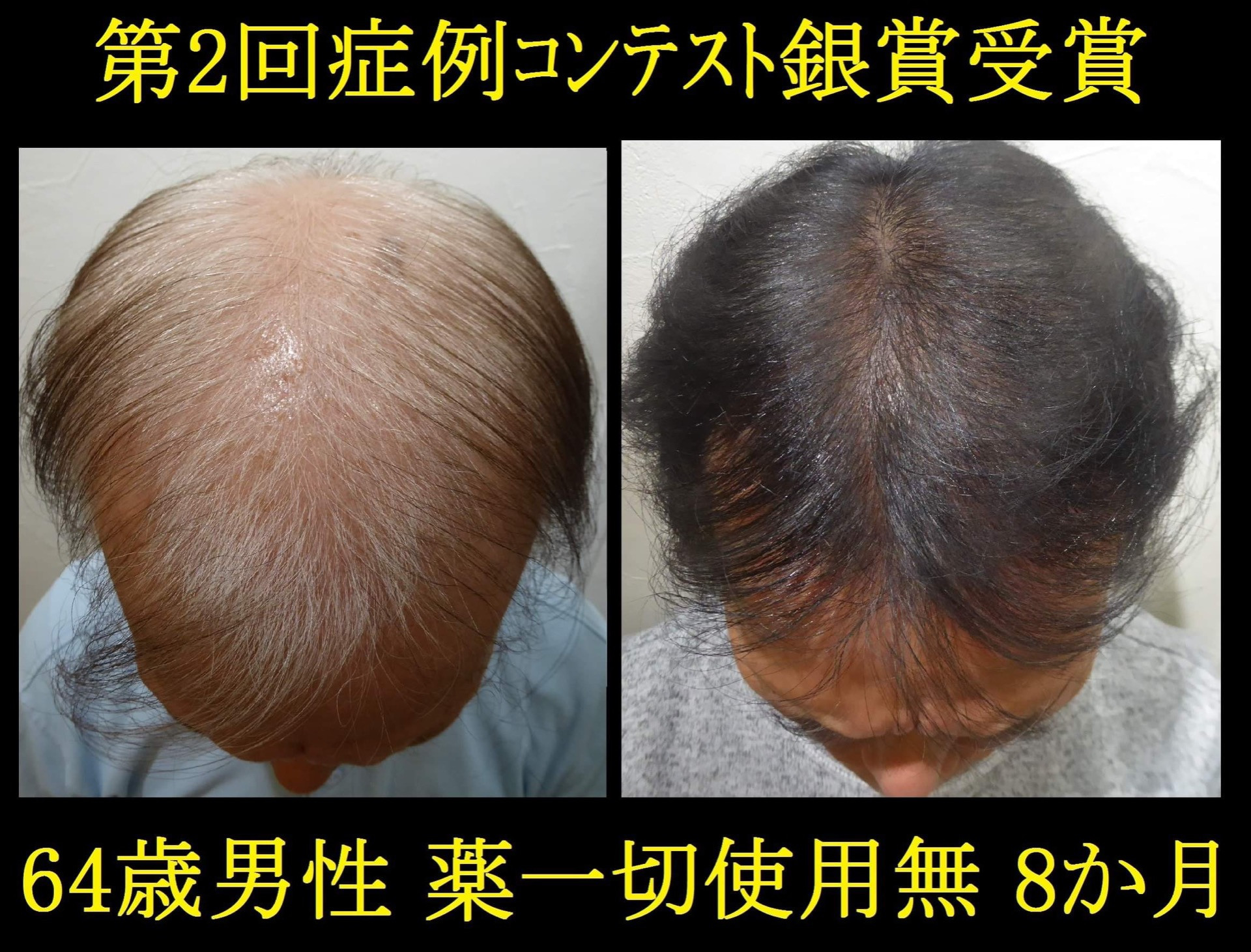 60代お薬無しで爆発毛！銀賞受賞したA様のコメントはいかに！？