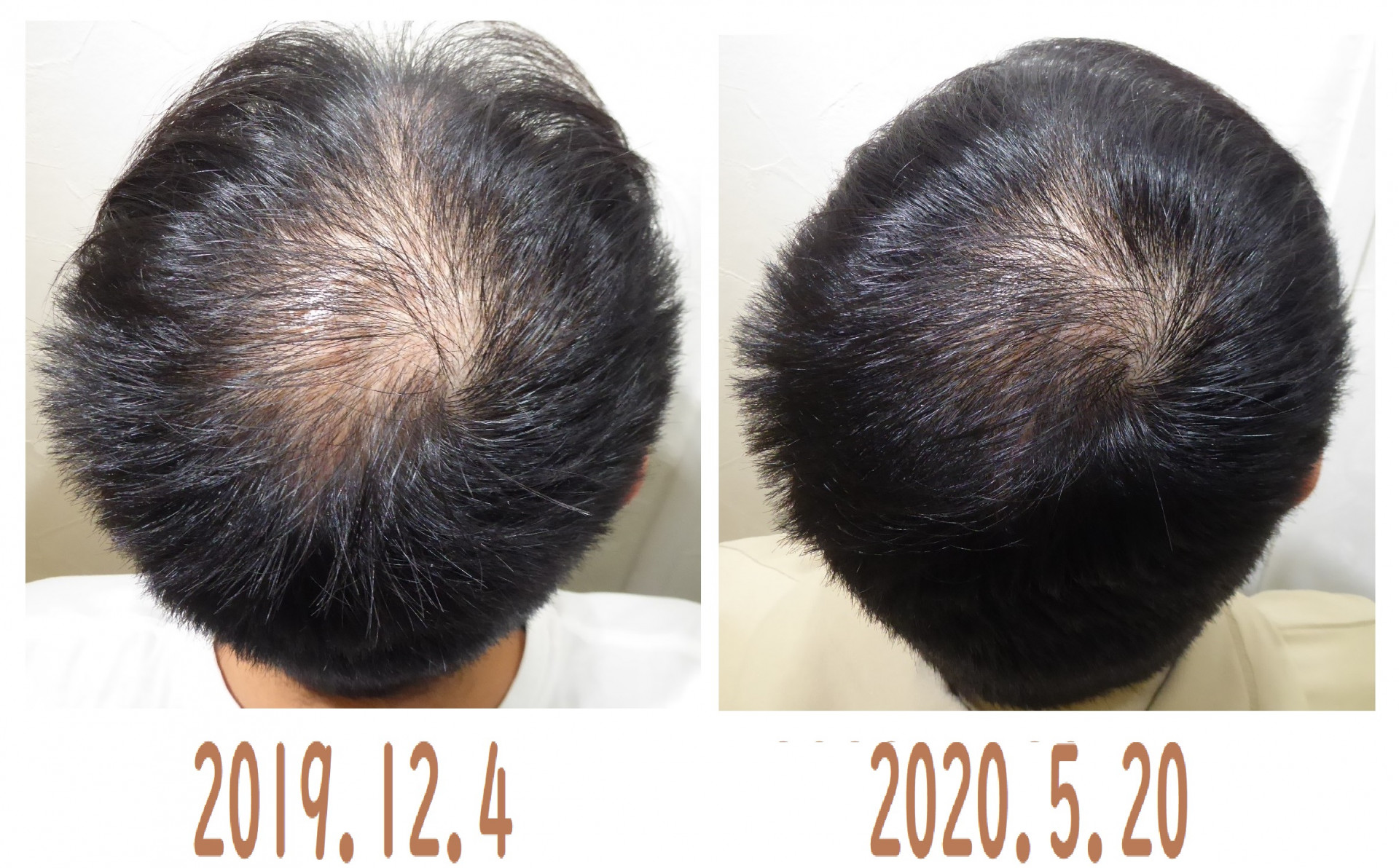 発毛する頭皮と発毛しない頭皮のビフォーアフター