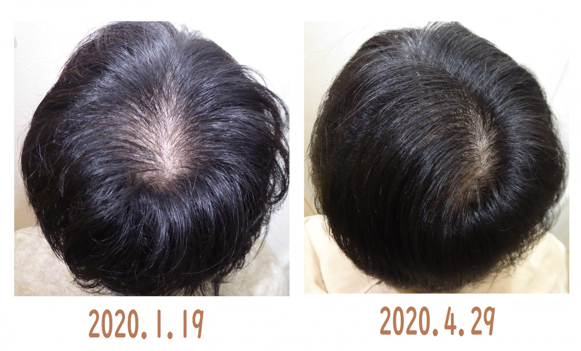 20歳の発毛は毛穴から　つむじの薄毛に効果抜群