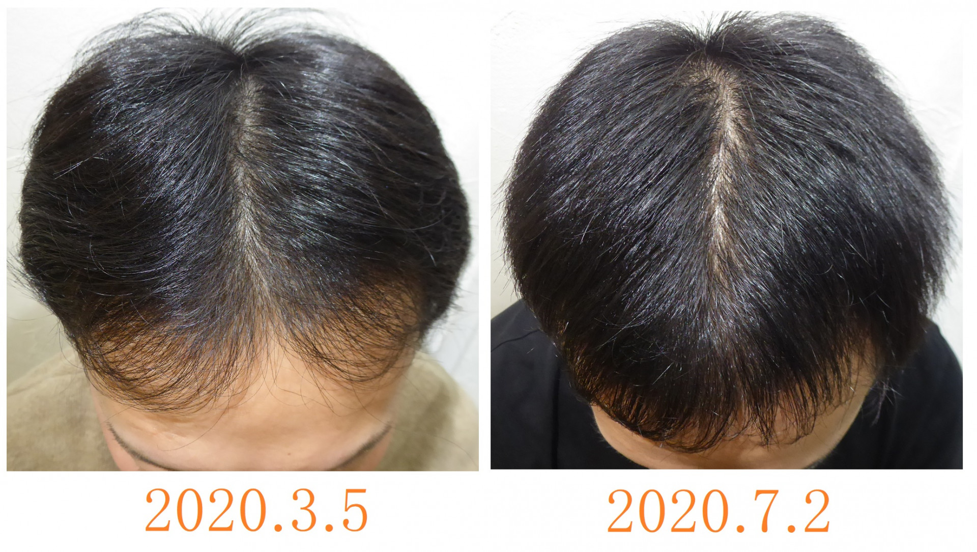 発毛に必要な事は何でしょう？