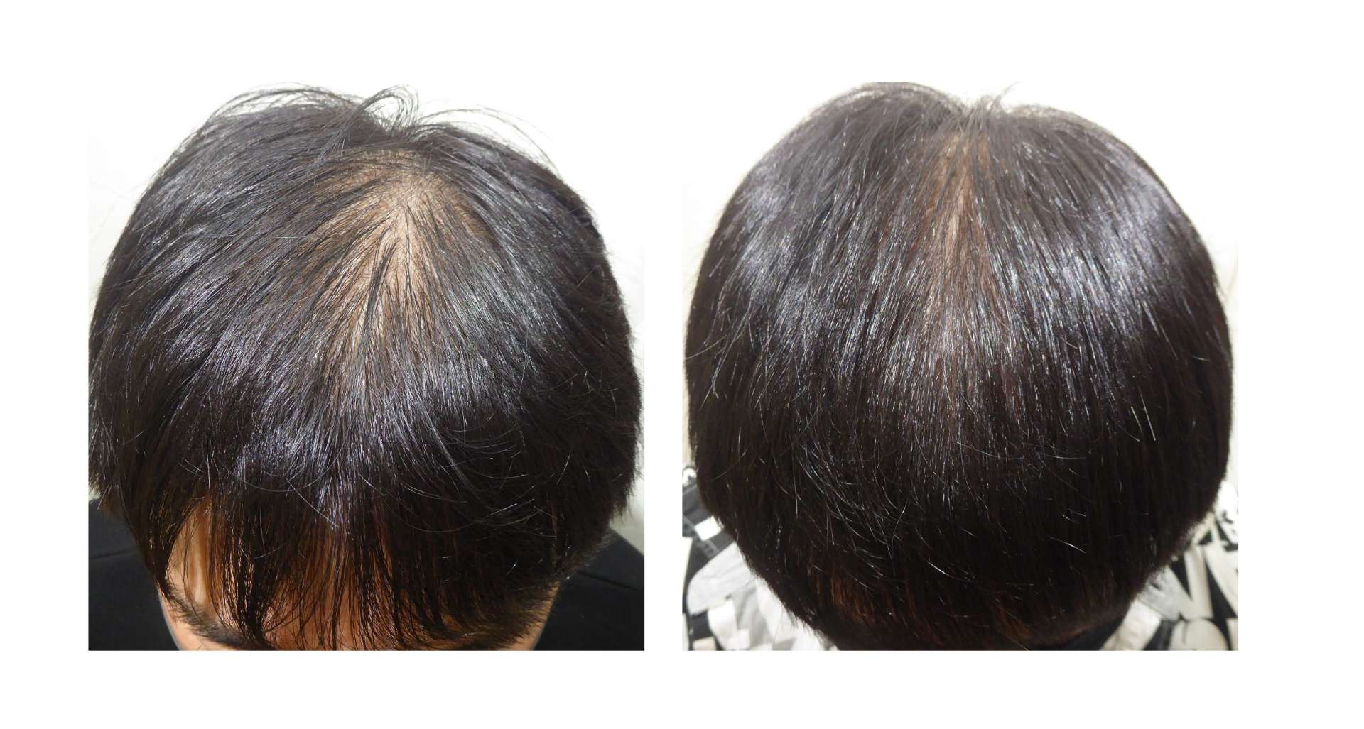 AGA・姫路発毛サロン      【20代で薄毛何が原因？？？】これやね・・・！