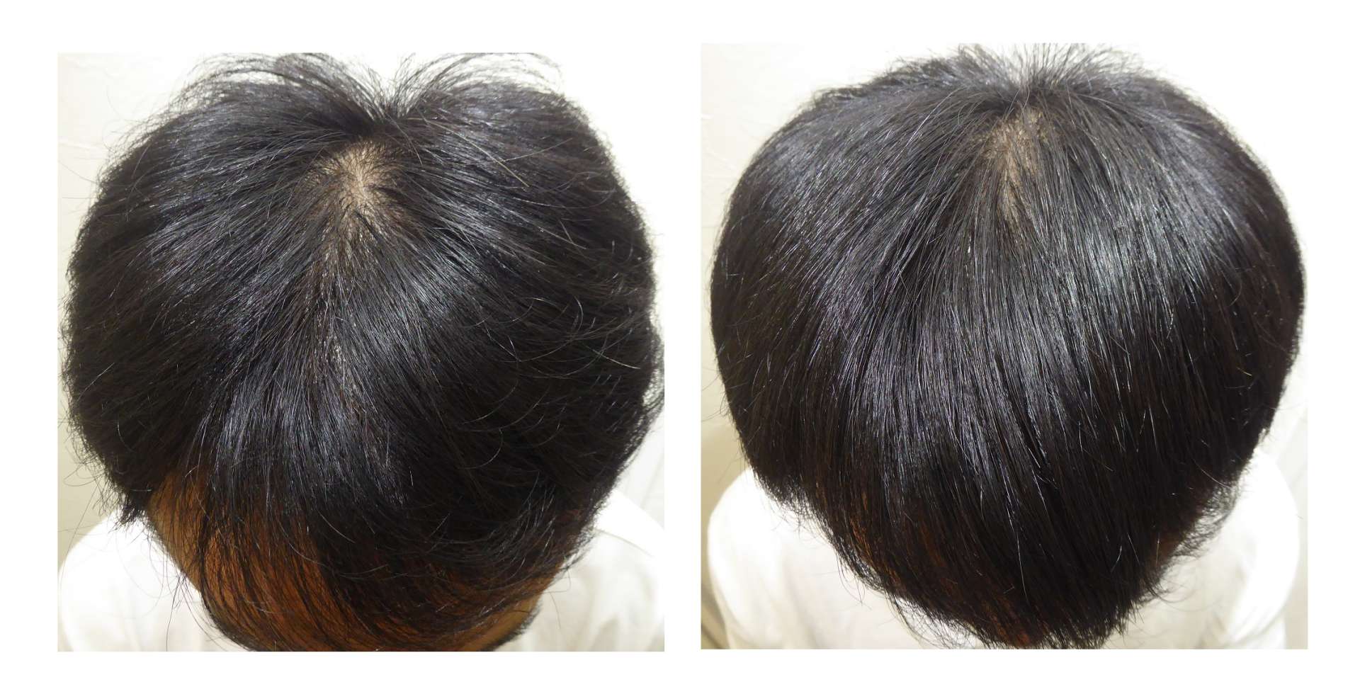 AGA・姫路発毛サロン      30代半ば【ミノキシジルなしで発毛】できる？