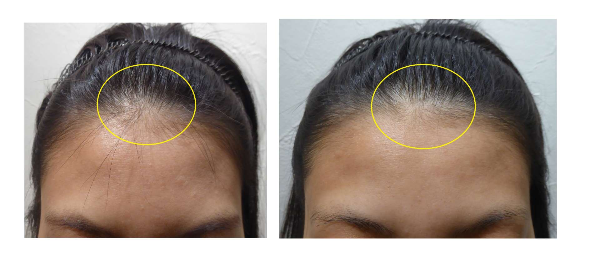 AGA・姫路発毛サロン　20代女性【薄毛に悩む・・・】