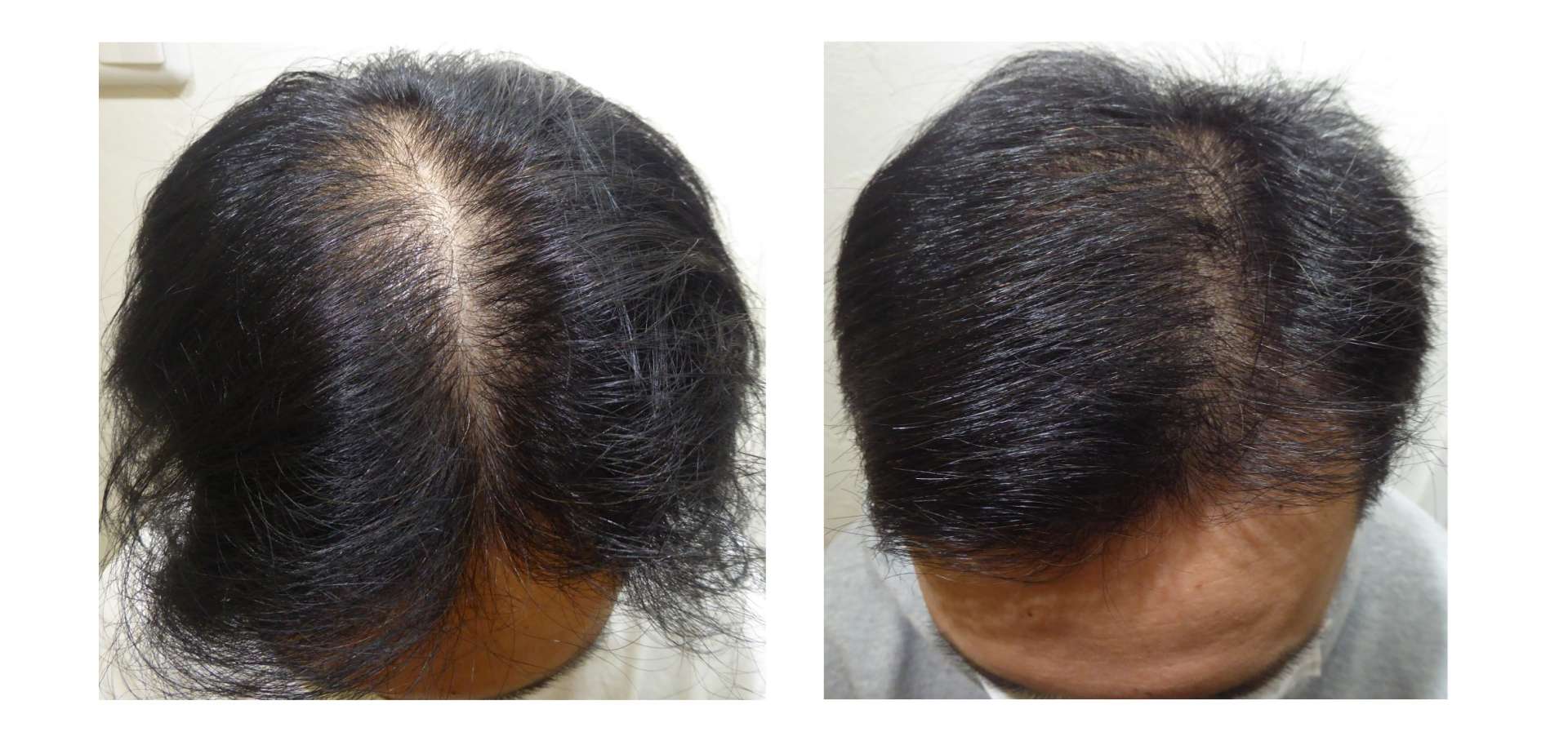 AGA・姫路発毛サロン　30代男性【ミノキシジル使用なし】で実感