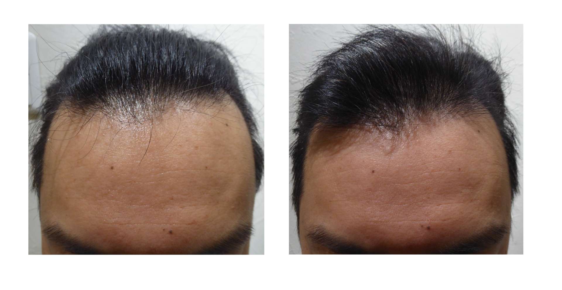 AGA・姫路発毛サロン　発毛に【亜鉛は効果がある？】