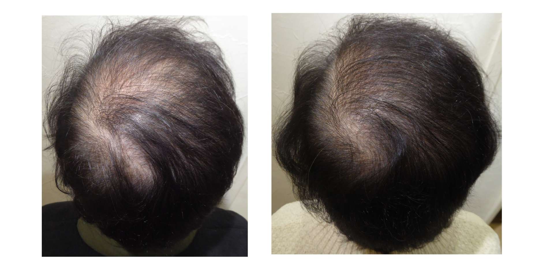 AGA・姫路発毛サロン　60代女性【今からでも髪の毛は生えてきますか？・・・】