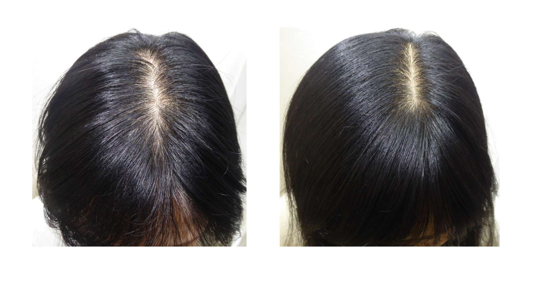 AGA・姫路発毛サロン　40代女性【お薬は使いたくありません・・・】