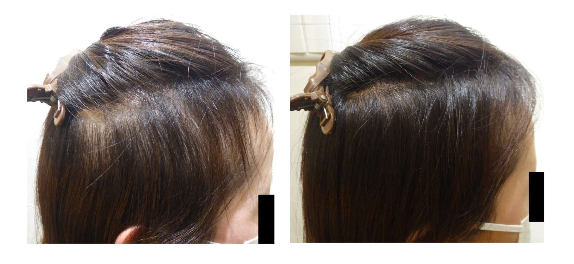 AGA・姫路発毛サロン　30代女性【髪の毛が伸びない…】