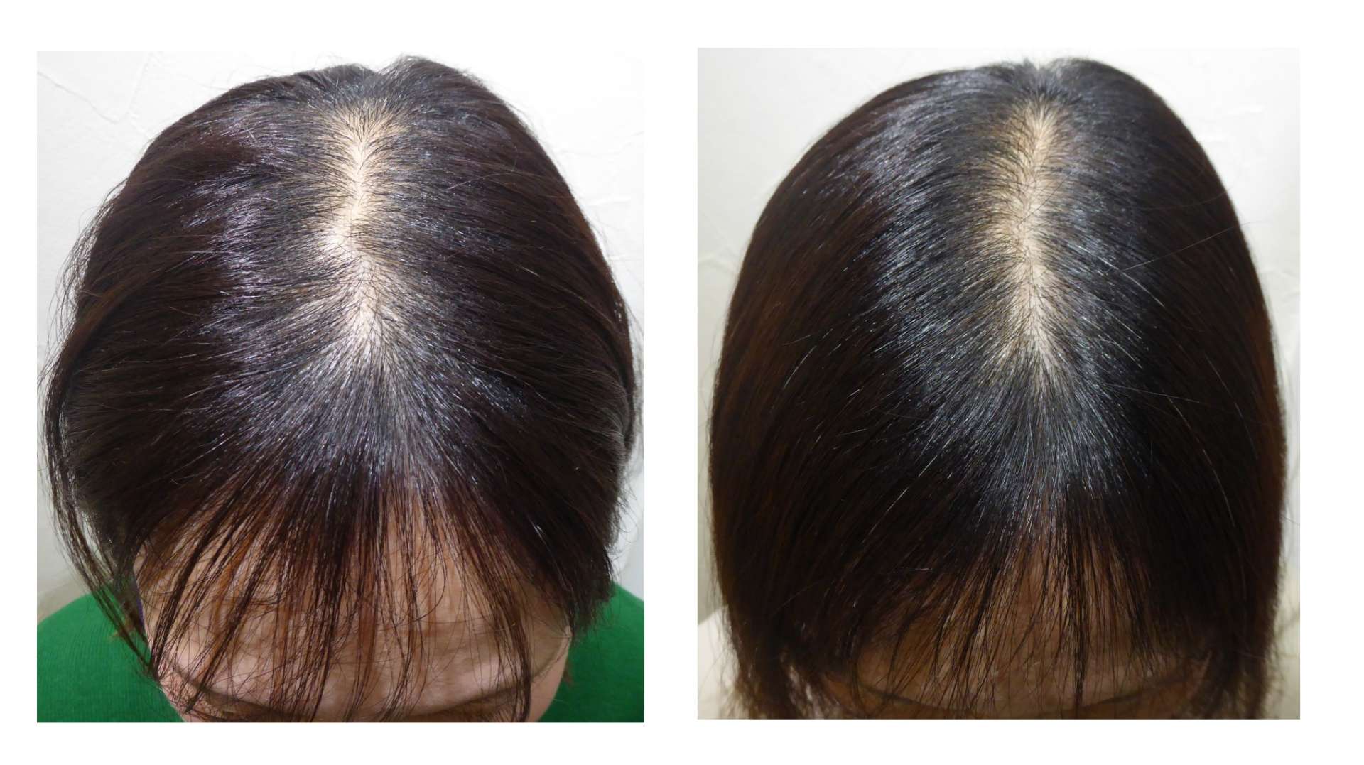 AGA・姫路発毛サロン　30代女性【髪の毛が気になって人と目が合わせられない・・・】