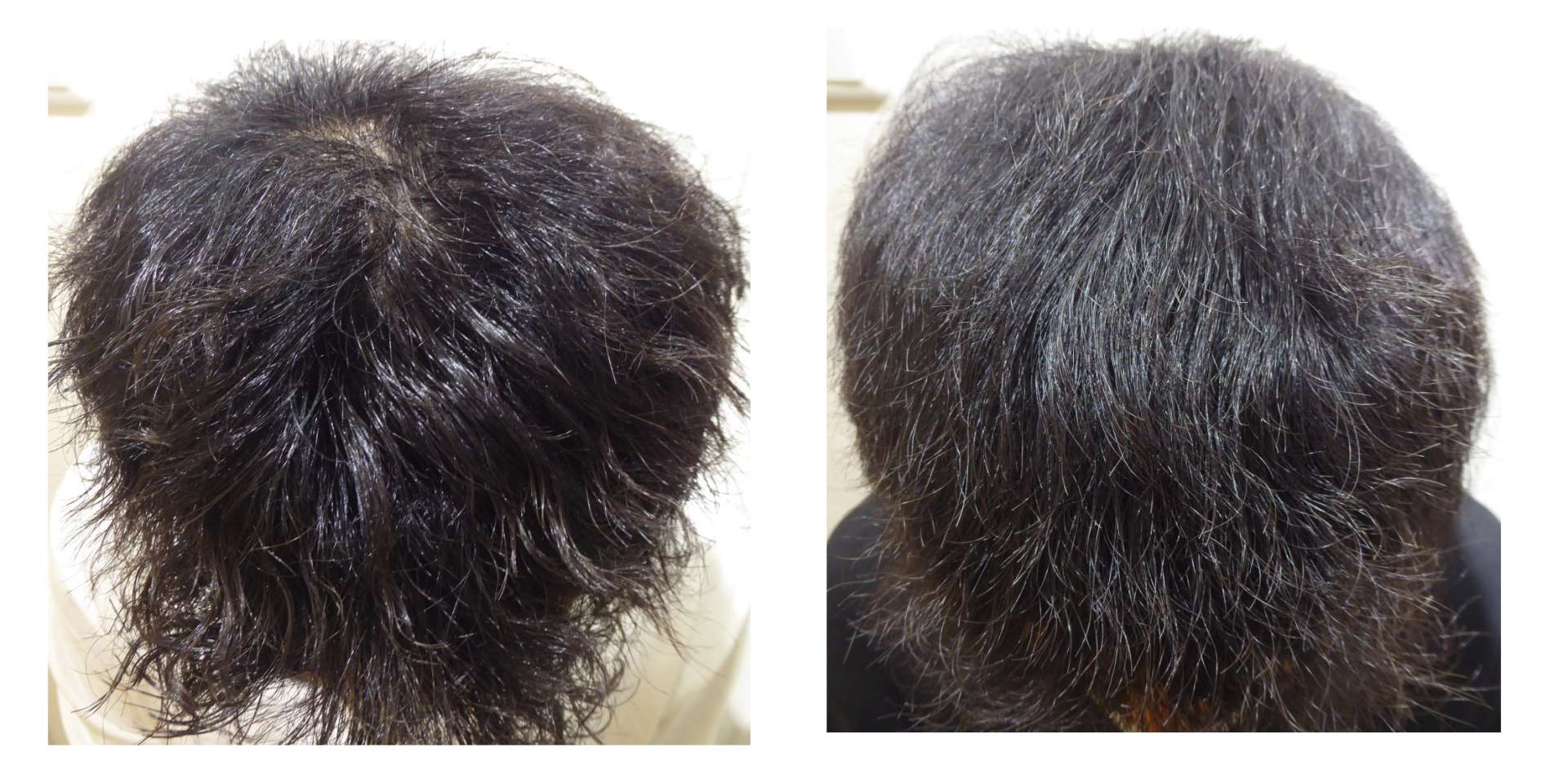 AGA・姫路発毛サロン　30代男性　【お薬止めても発毛しますか？？】