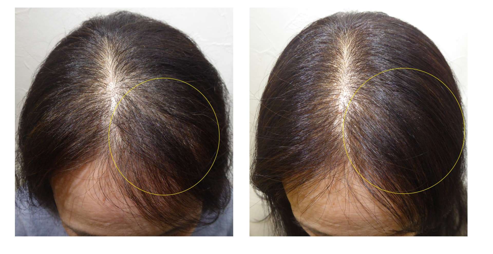 AGA・姫路発毛サロン　50代女性　【髪の毛生えるかな？】＆ゴールデンウイークのお知らせ