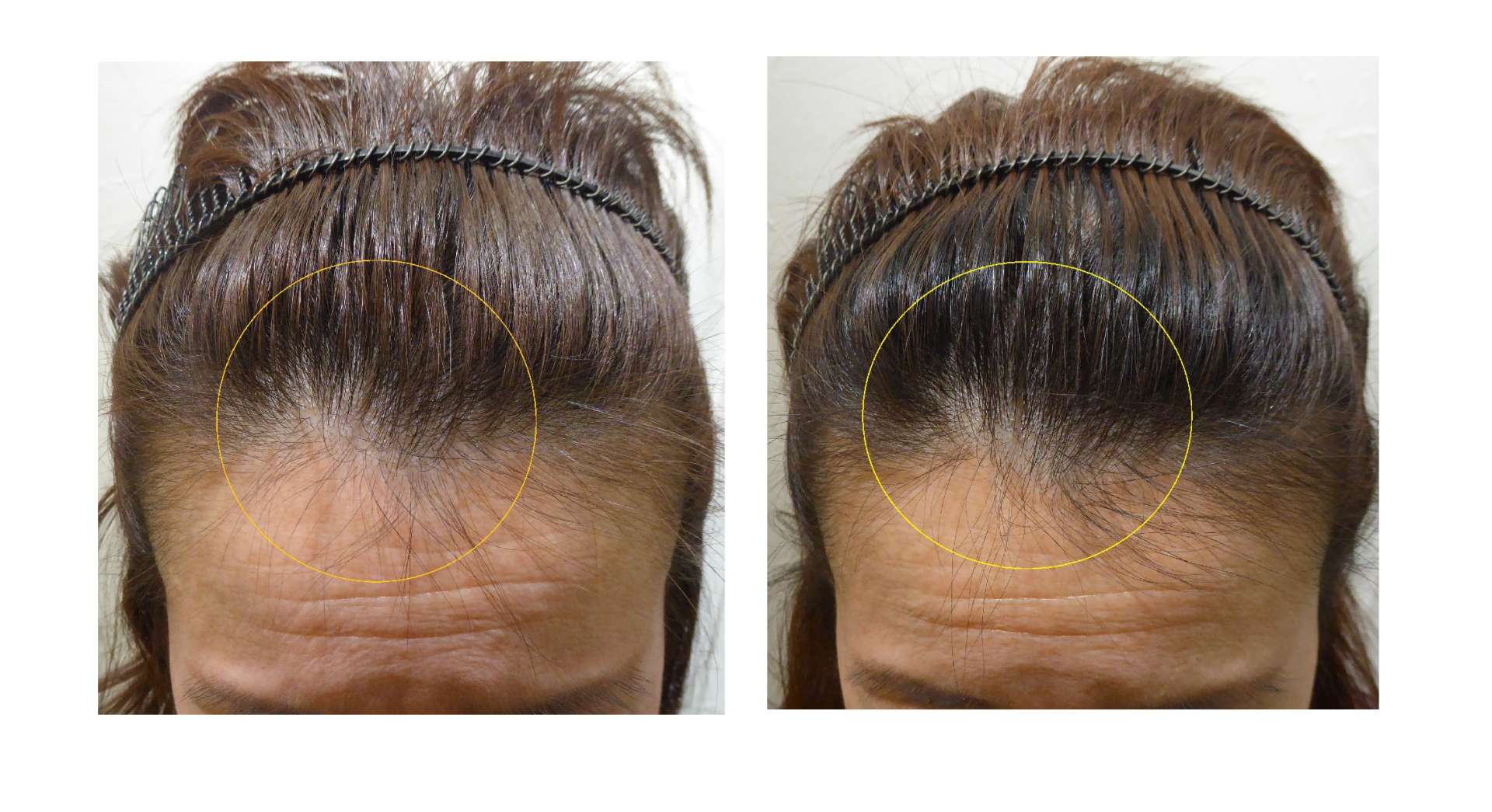 AGA・姫路発毛サロン　50代女性　【髪の毛元に戻りますか？】
