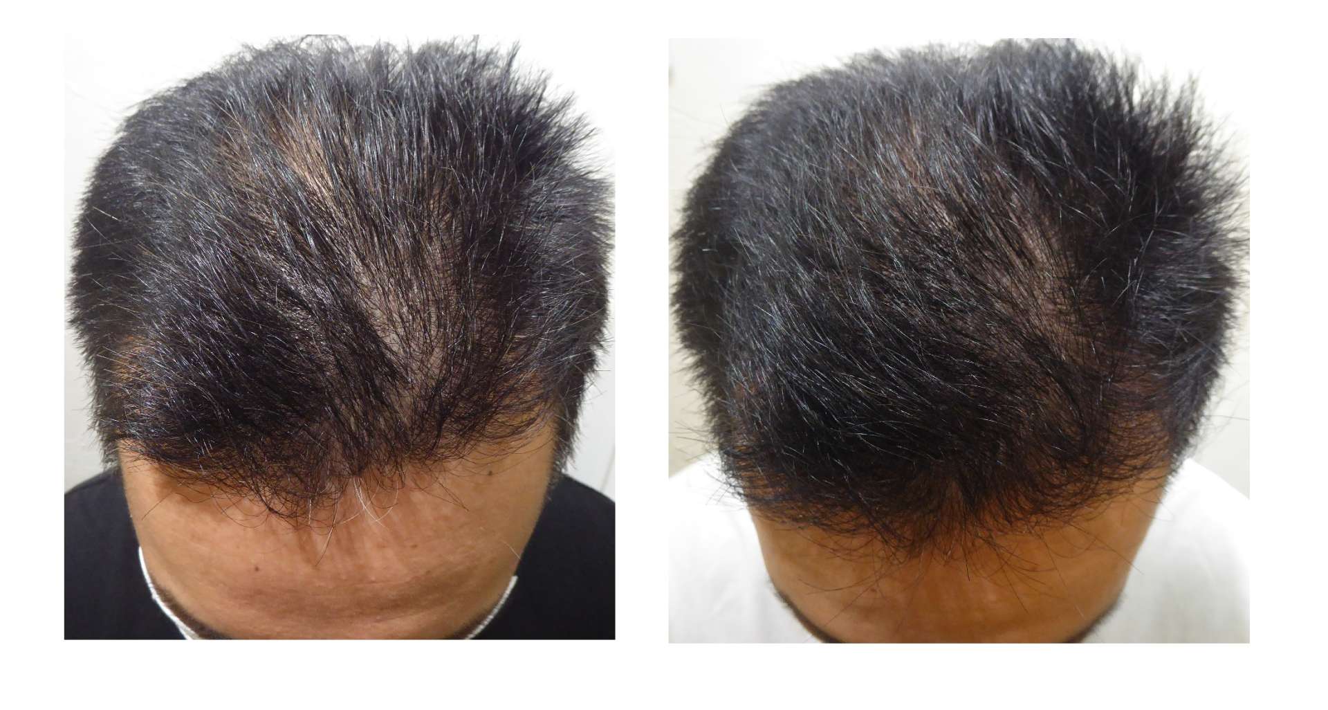   AGA・発毛サロン　30代男性【自然に髪の毛が生えるなら・・・】