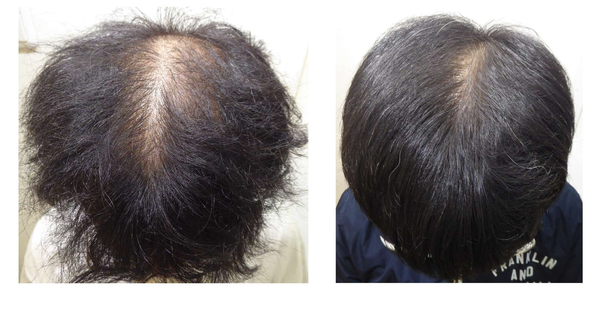 AGA・姫路発毛サロン　30代男性【絶賛発毛中・・・！！】