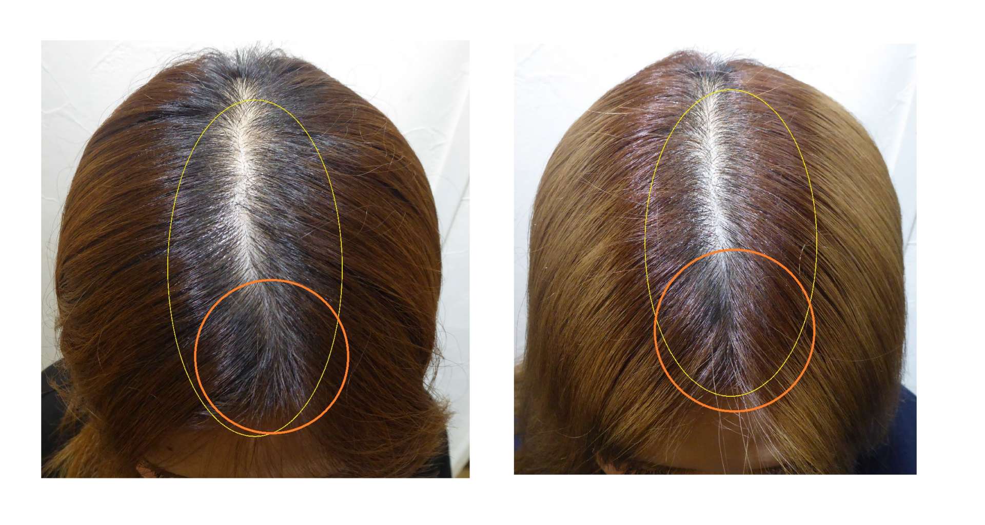 AGA・姫路発毛サロン　30代女性　【カラーは頭皮を痛めます！！】