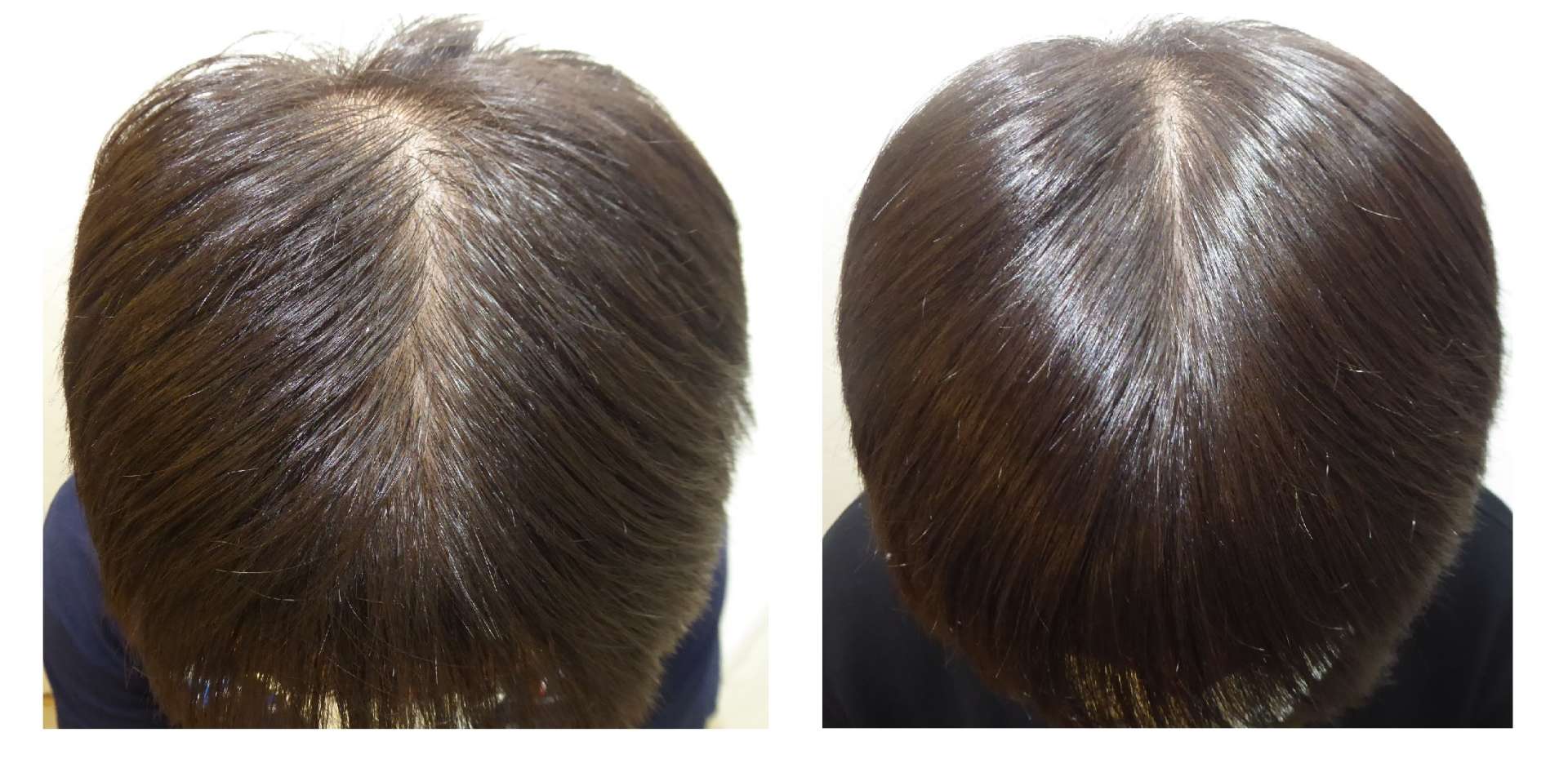 AGA・姫路発毛サロン　【抜け毛の症状がある病気とは？】