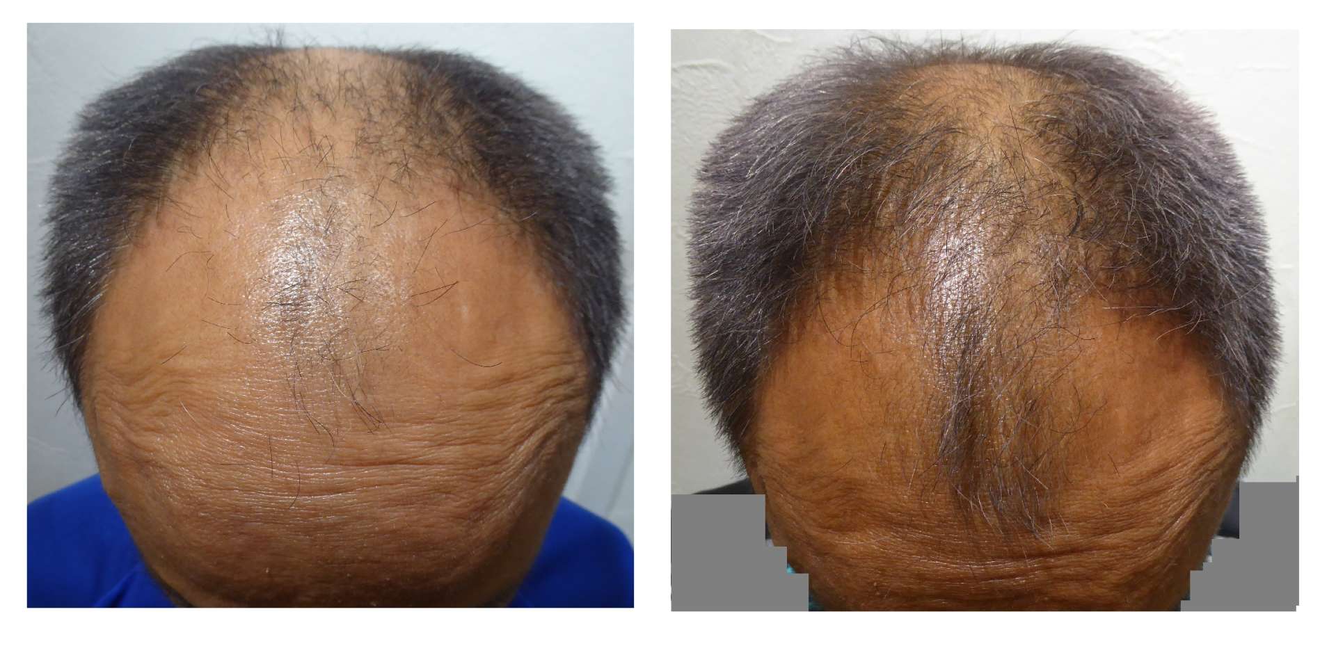 AGA・姫路発毛サロン　60代【諦めない発毛・・・！】