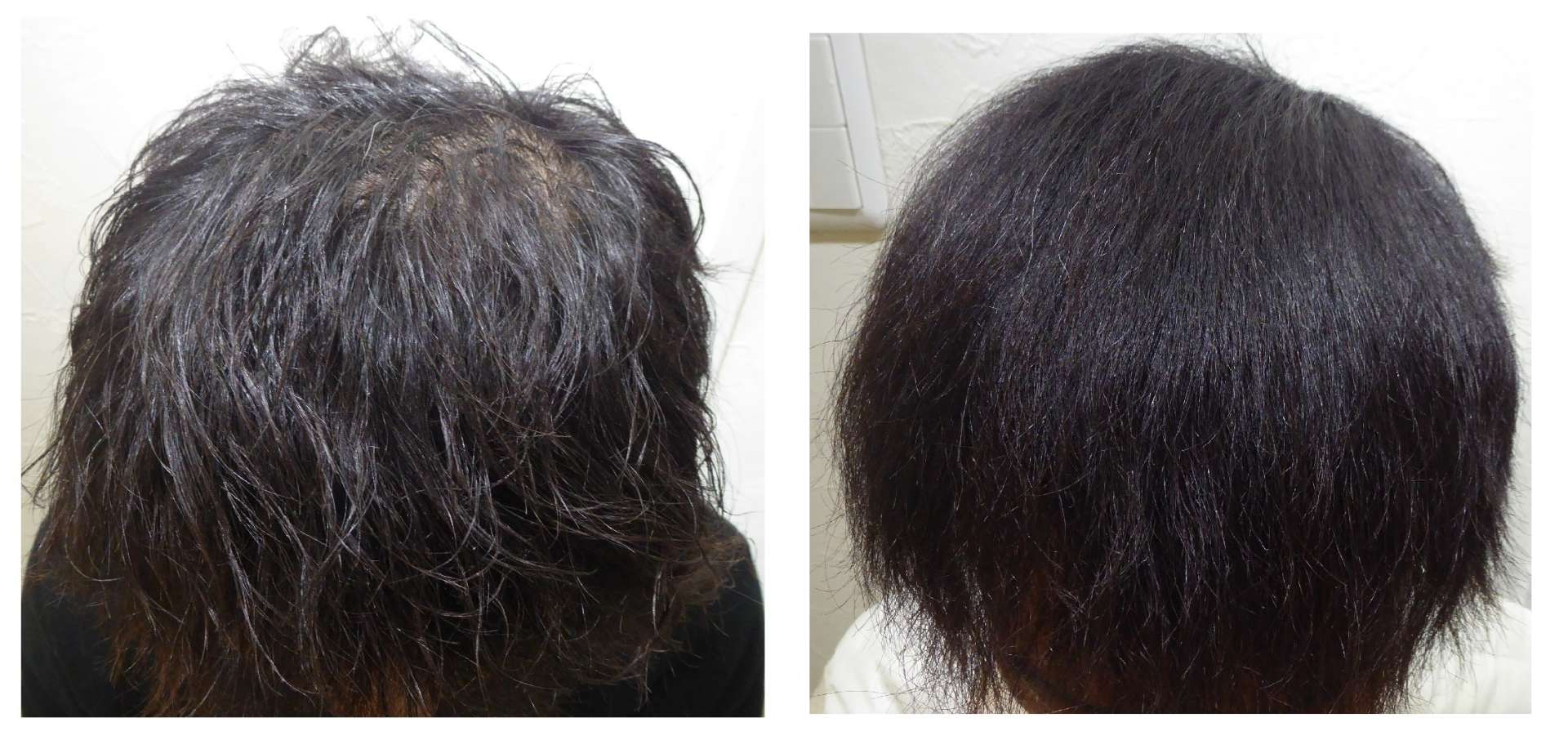 AGA・姫路発毛サロン　40代男性【1か月経たずに発毛！！】