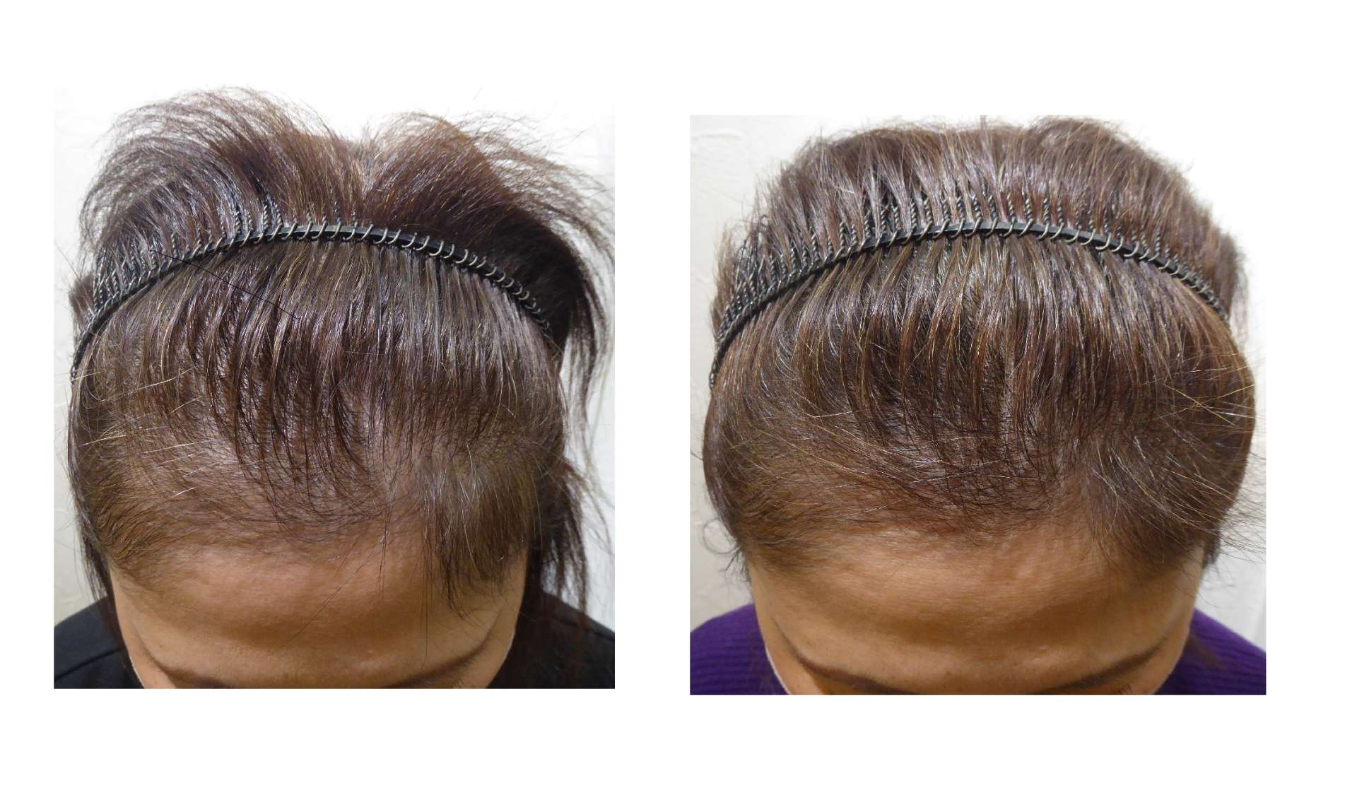 AGA・姫路発毛サロン　40代女性【一部分だけ髪の毛が生えてこない・・・】