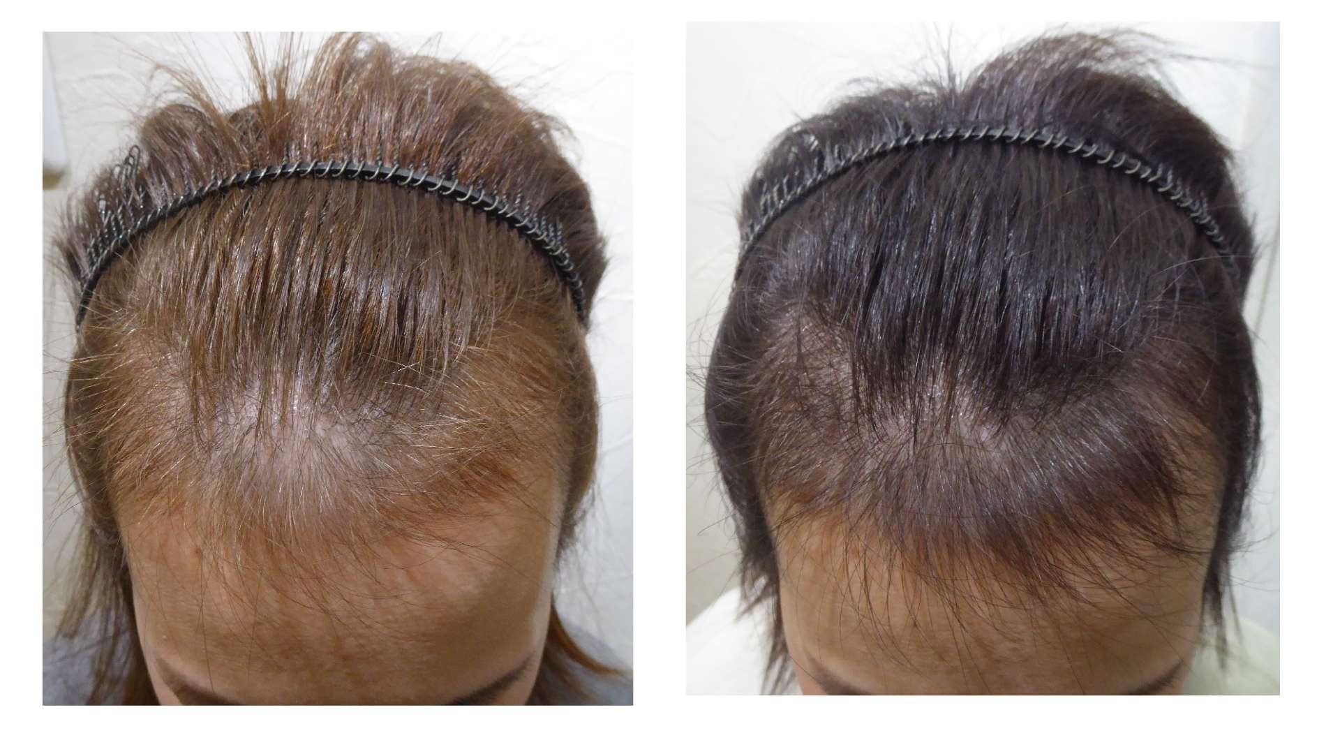 AGA・姫路発毛サロン　40代女性　女性の皆さん【薄毛は他人事ではありませんよ！！】