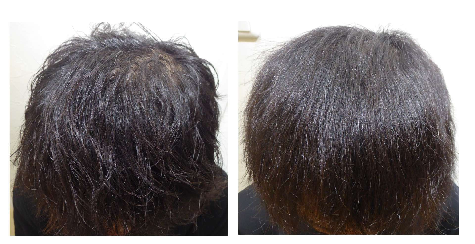 AGA・姫路発毛サロン　40代男性【お薬なしで発毛】