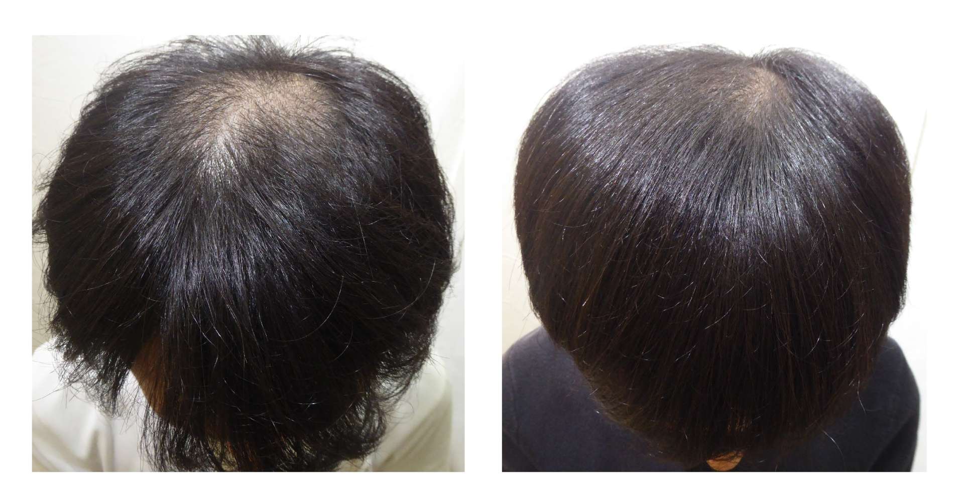 AGA・姫路発毛サロン　2025【スーパースカルプ大会エントリー症例】№3
