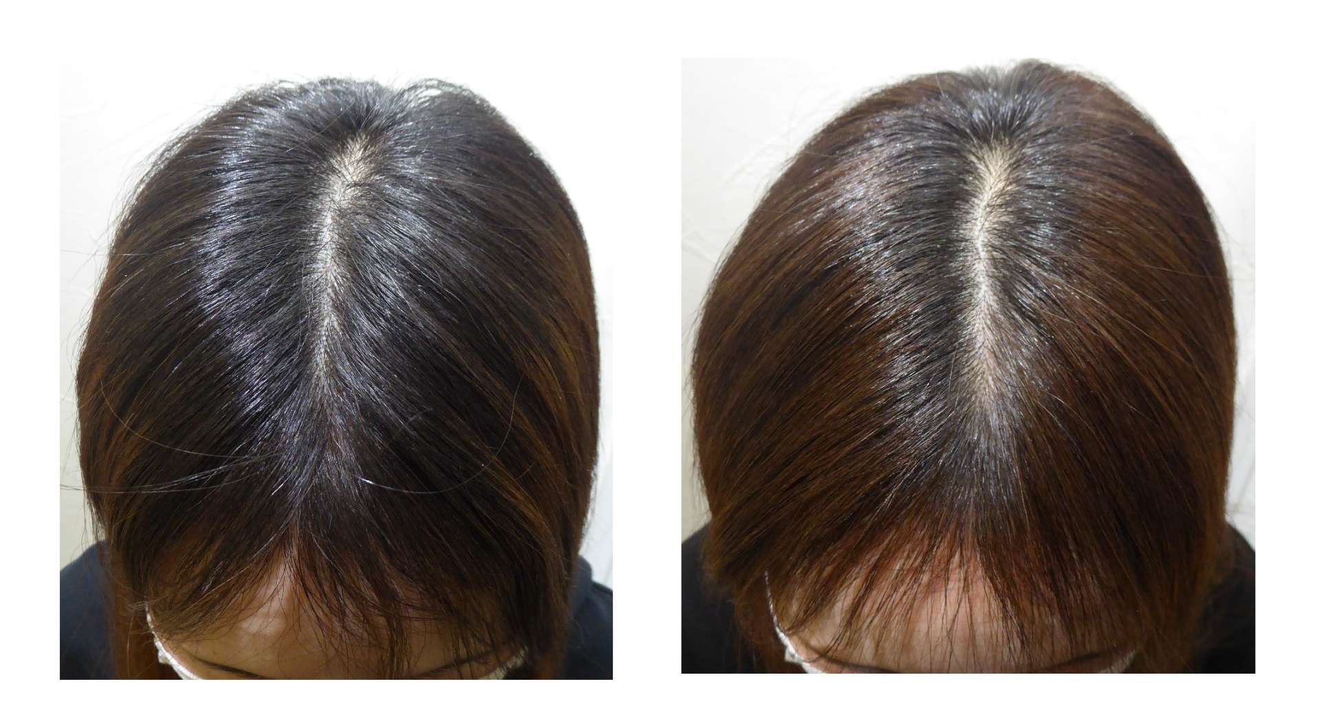 AGA・姫路発毛サロン　2025【スーパースカルプ大会エントリー症例】№4