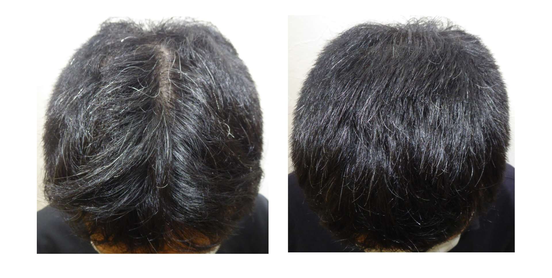 AGA・姫路発毛サロン　2025【スーパースカルプ大会エントリー症例】№7