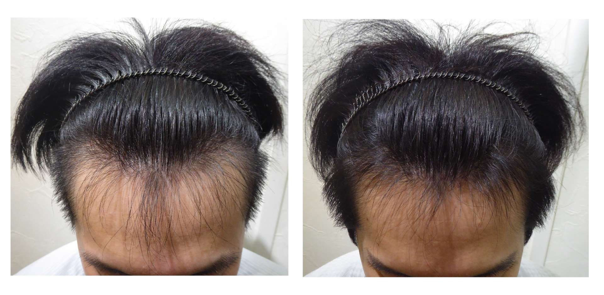   AGA・発毛サロン　20代男性【ミノキシジル飲まなくても良いですか？】