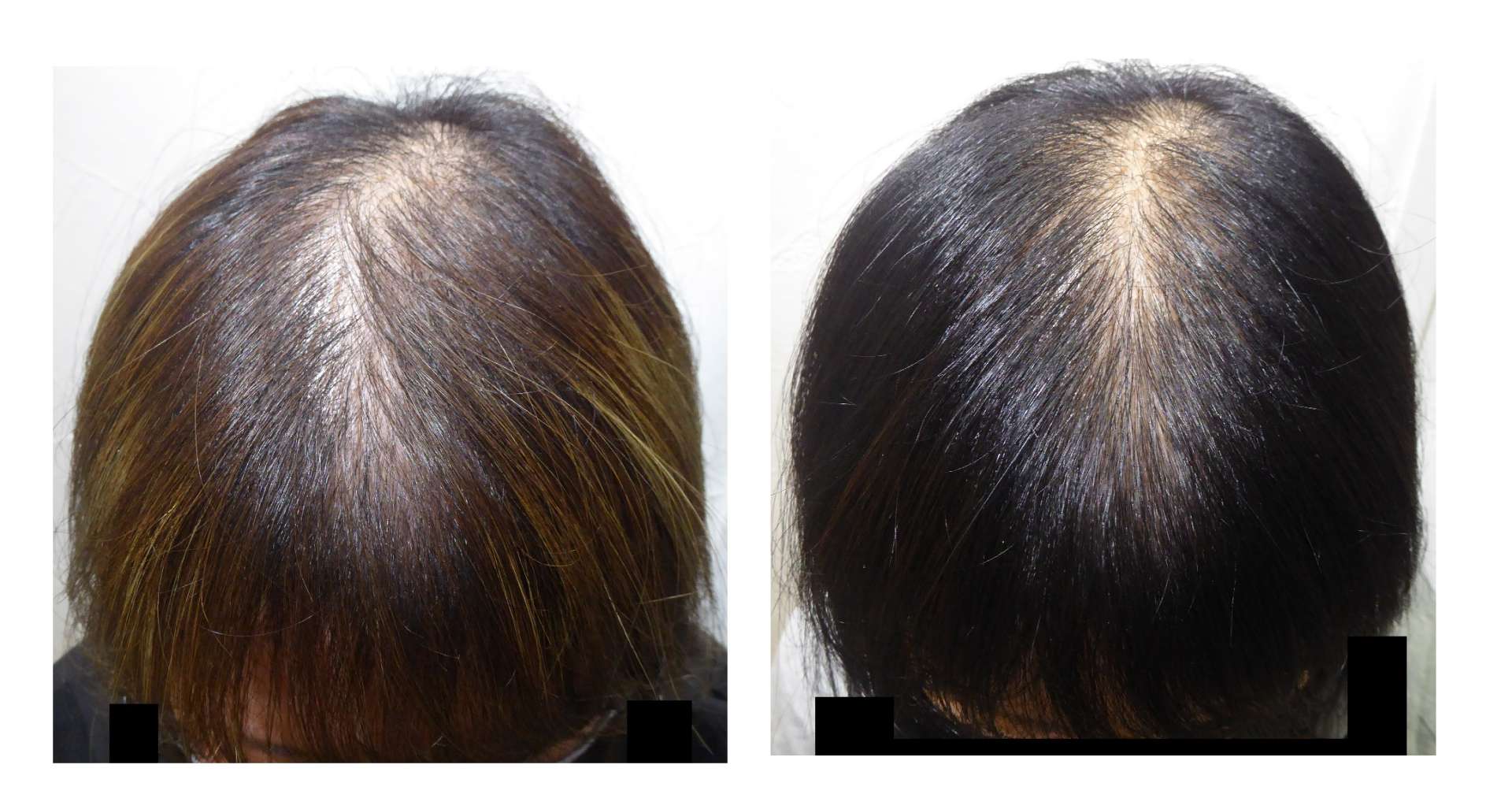   AGA・発毛サロン　30代女性【髪の毛元に戻りますか？】