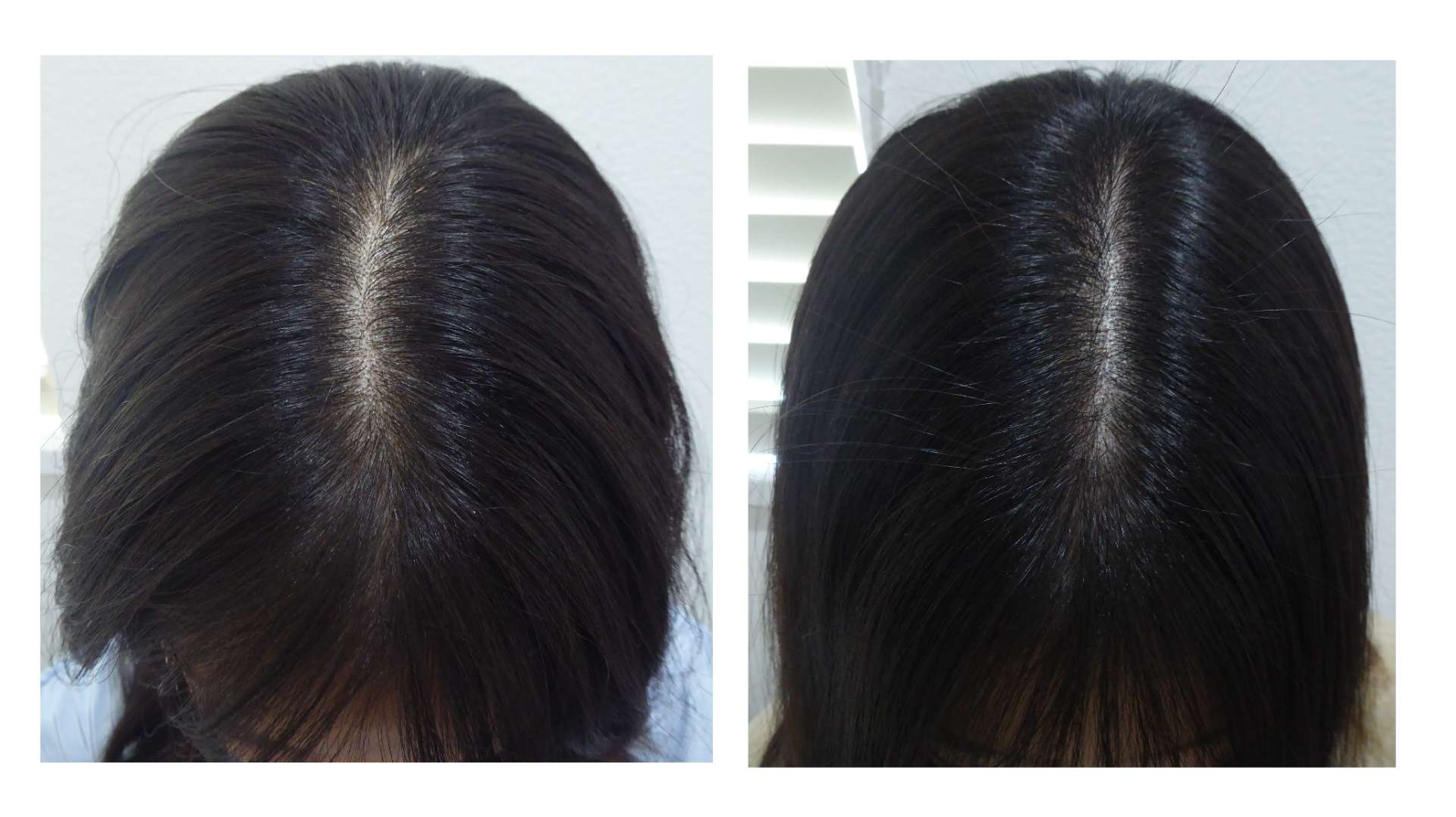 AGA・姫路発毛サロン　今年話題になっている【乾燥で抜け毛？？？】