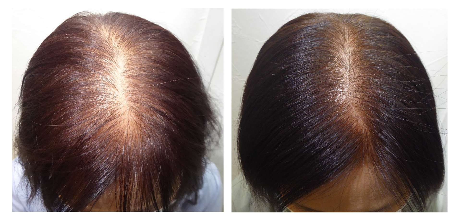 AGA・姫路発毛サロン　サロン選びで【後悔しない為】に大切なこと！！