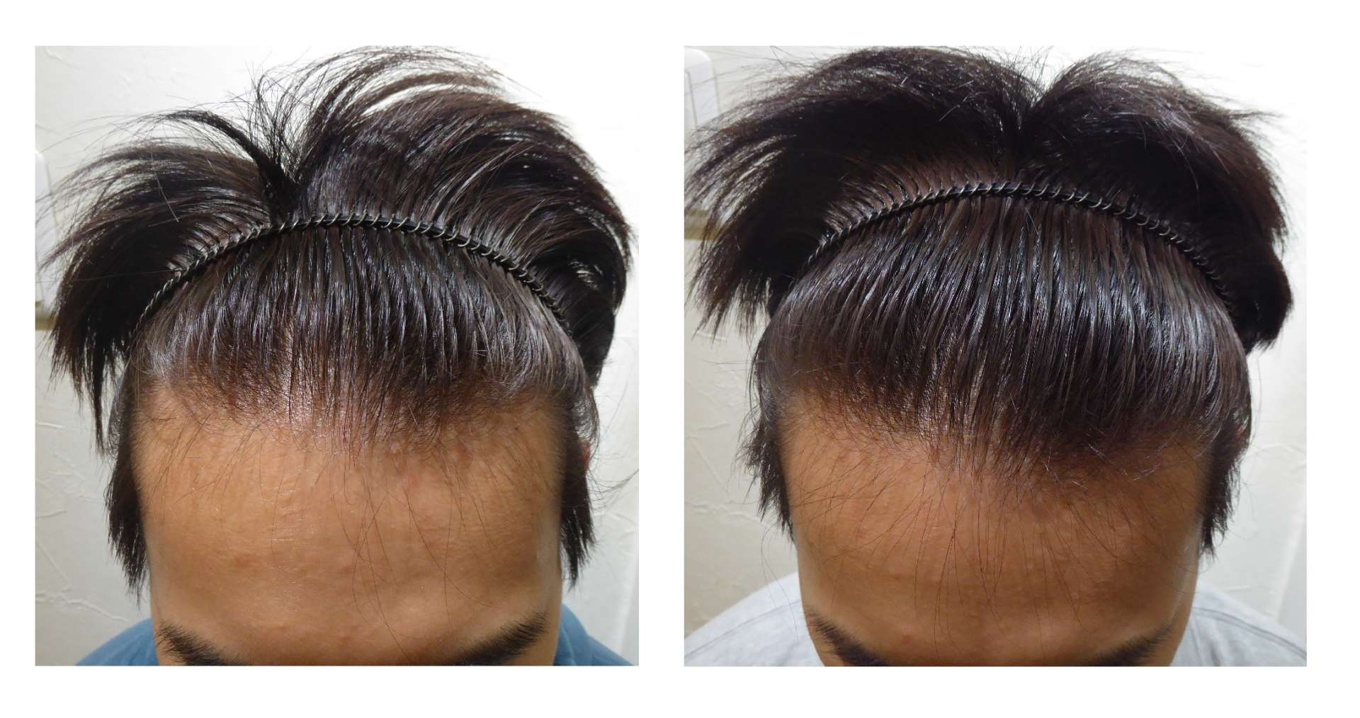 AGA・姫路発毛サロン　発毛にいい食事とは？