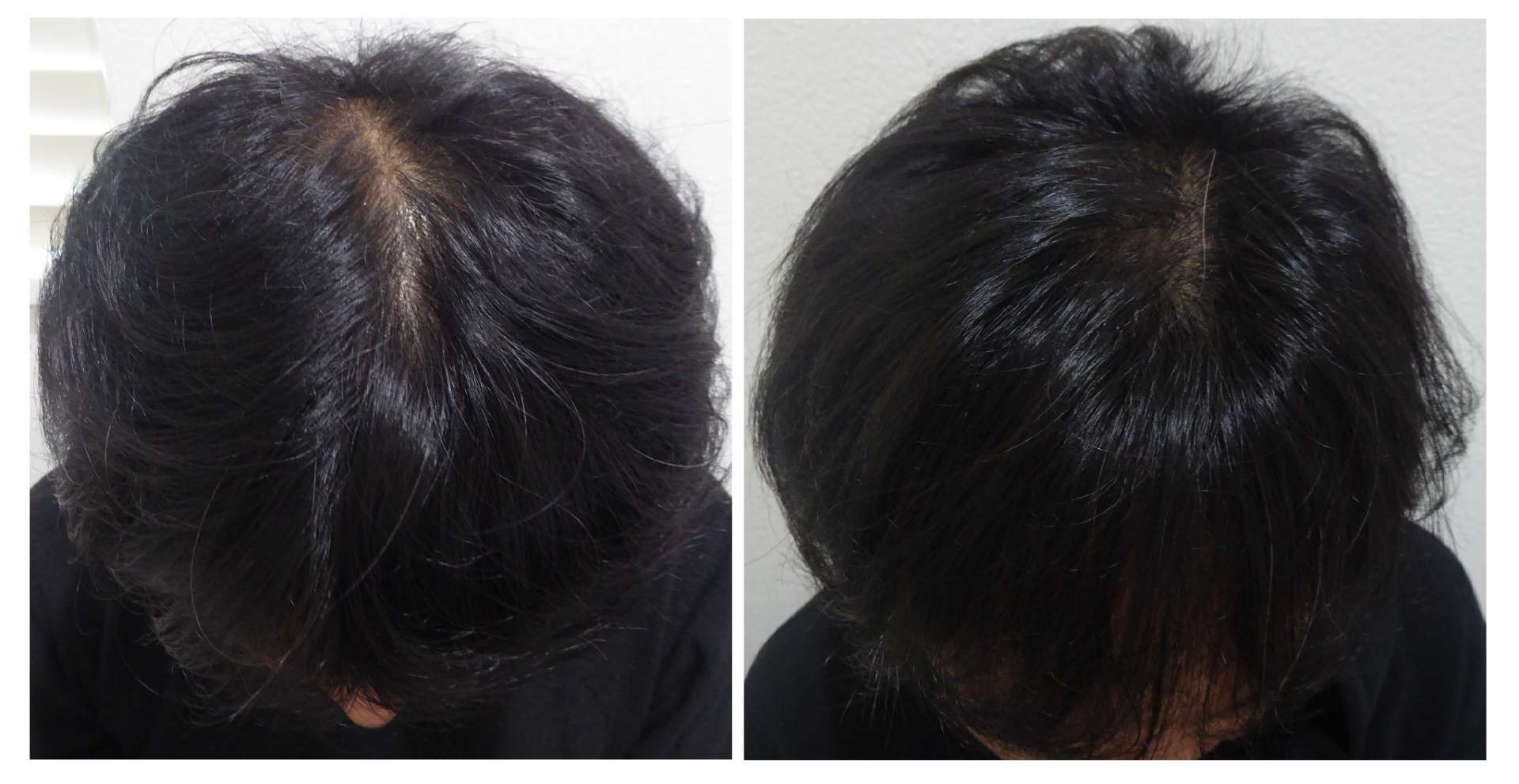 AGA・姫路発毛サロン　〇〇〇ではあまり言われない薄毛の原因