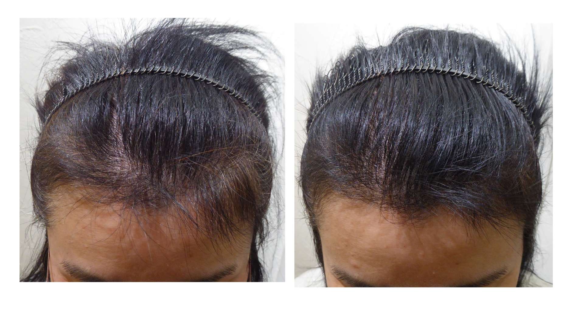 AGA・姫路発毛サロン　春は“発毛に影響が出てくる季節”